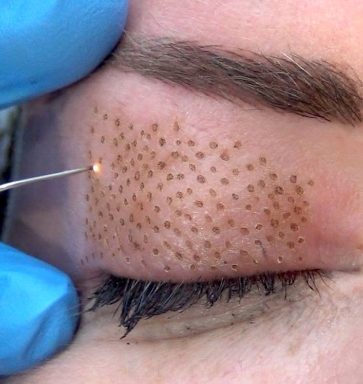 Actual Results You Can Expect after Plasma Fibroblast Therapy - Skin Delux