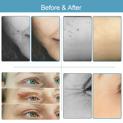 4TH Mole Remover Plasma Pen Fibroblasts PAA Ozone Freckle Tag Wart Removal with Replace Needles Beauty Care Tools